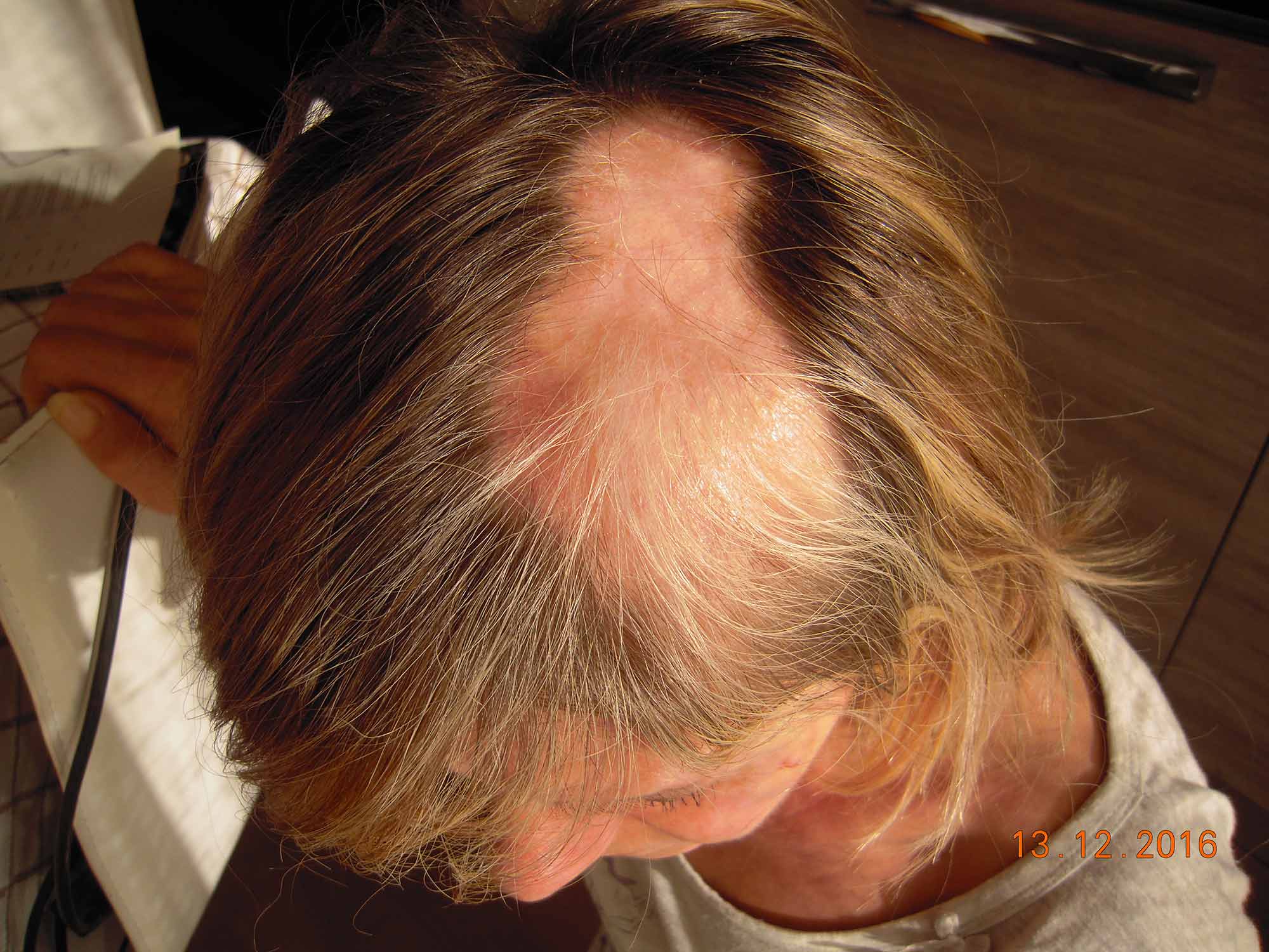 alopecia areata cura naturale